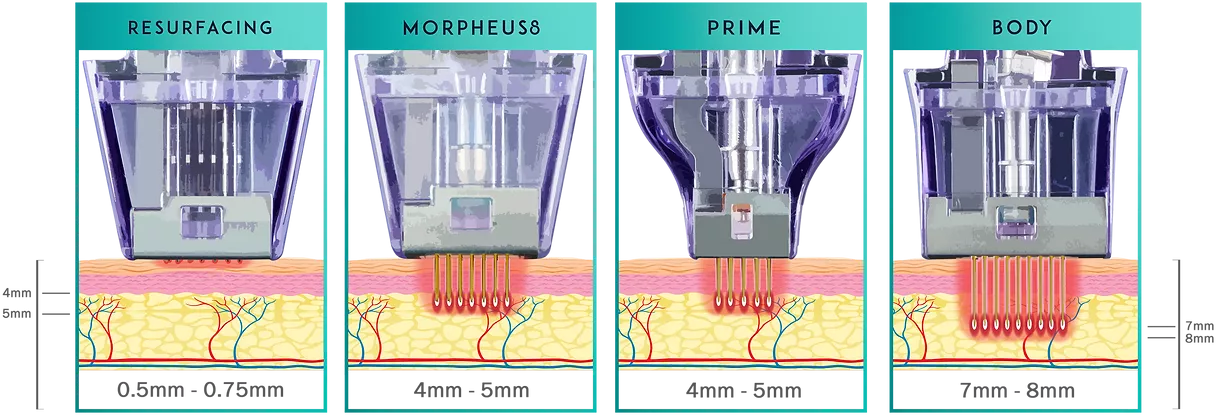 Morpheus8 - Radiofrequenz in Verbindung mit Microneedling, Faltenbehandlung