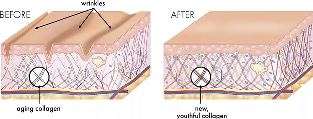 Morpheus8 - Radiofrequenz in Verbindung mit Microneedling, Faltenbehandlung