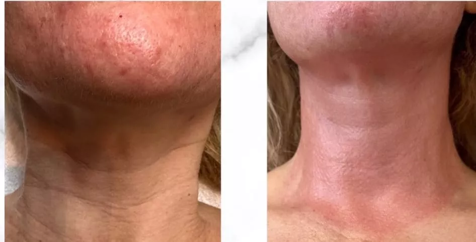 Morpheus8 - Radiofrequenz in Verbindung mit Microneedling